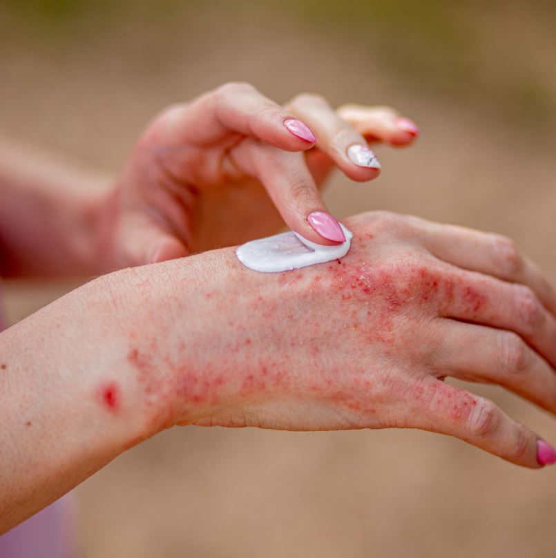 Skin Lesions on Hands